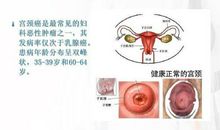宫颈癌淋巴结转移因素分析论文