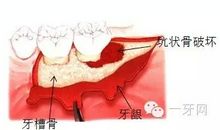 什么是牙周组织病，它是怎么发生的？