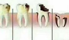 补牙为什么越早越好？