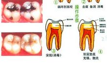 龋病是怎样变化发展的？