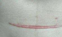 永远擦不掉的伤疤