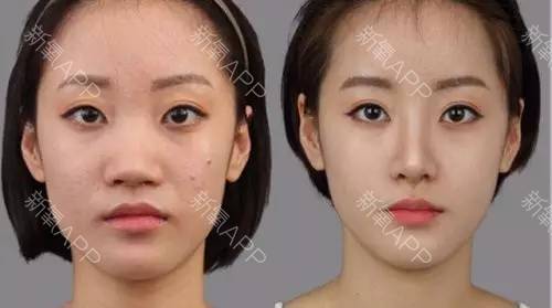 鼻子痛的经历