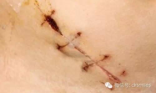 伤口的秘密
