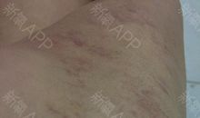 谁说疤痕不美丽