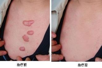 疤痕依然美丽