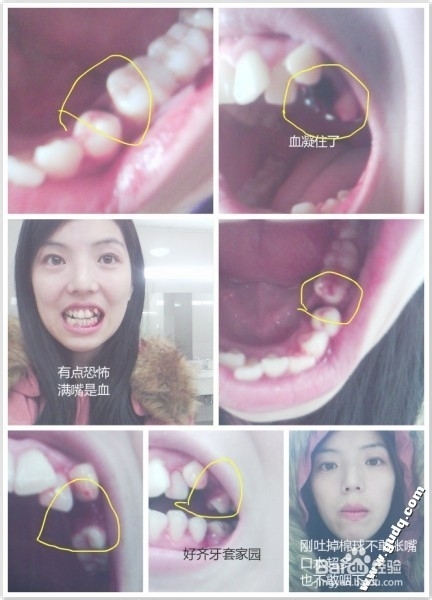 拔牙经验