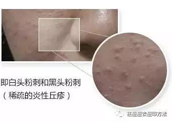 烦人的粉刺