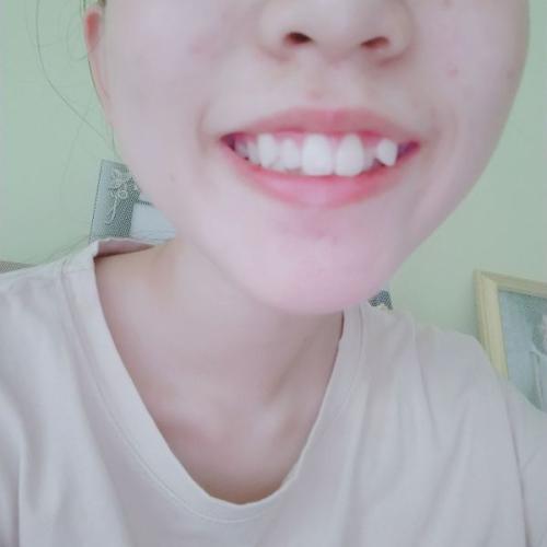 我的前牙不见了