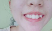 我的门牙不见了