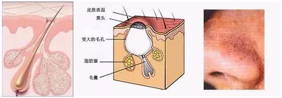我与“黑头粉刺”的战斗
