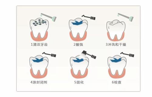 进行凹坑和裂缝封闭