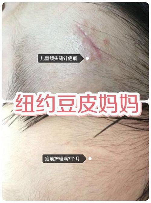 疤痕