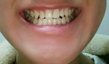 我是一颗小门牙