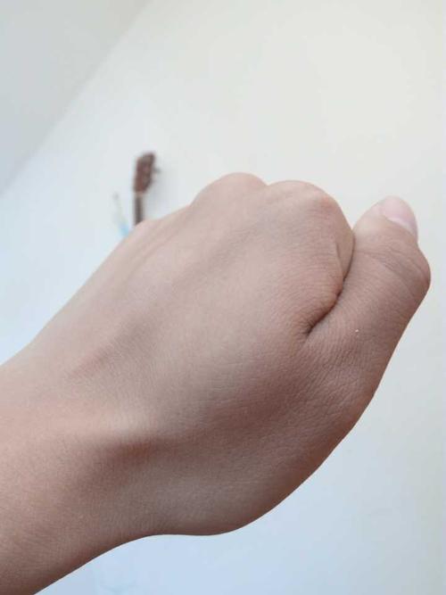 手肿
