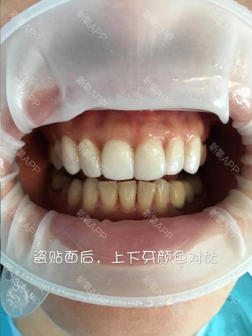 吞咽牙齿