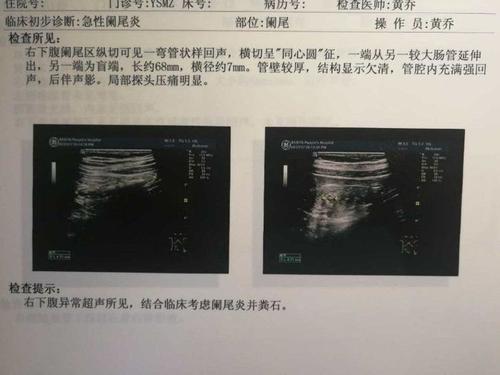 阑尾炎手术