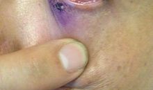 老爸的眼“伤”