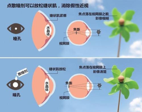 瞳孔散大