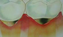 蛀牙大军的胜利