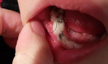 我发现了蛀牙的秘密