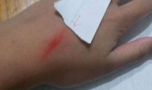 手心上的那条疤痕