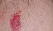 我和我的红胎记