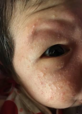 关于脸上痤疮的成分