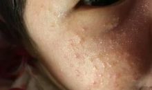 关于脸上长痘痘的作文