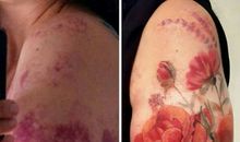 我因胎记而与众不同