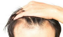 青年怎不知脱发苦