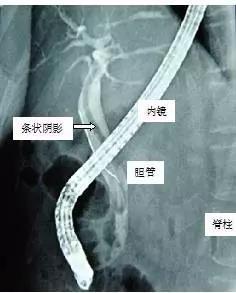 虫事件
