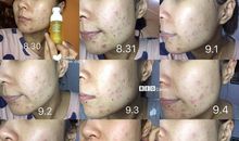 我的“战痘”记