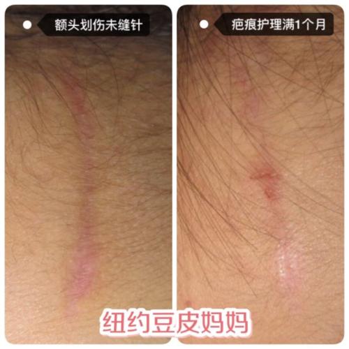 母亲身上的两道伤疤