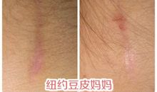 母亲身上的两道伤疤