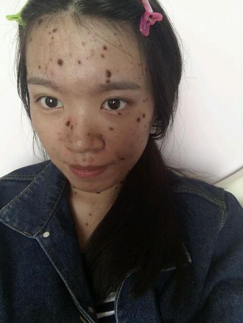 水痘来了