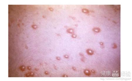 这都是“水痘”造成的