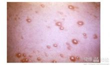 都是“水痘”惹的祸