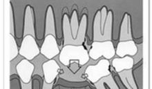 “缺牙齿”的故事