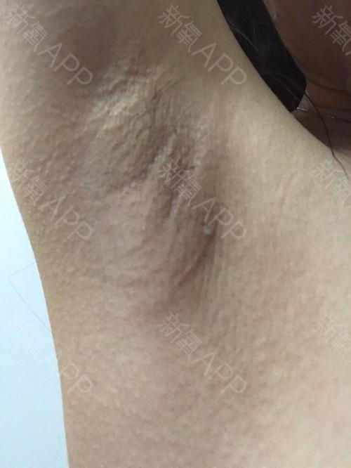 疤痕生长最美丽