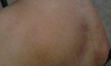 那一次，脚扭伤了