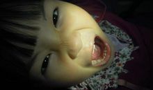 难忘的第一次拔牙