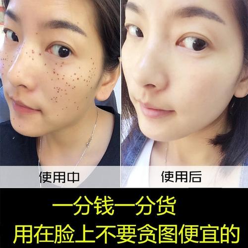 拿痣