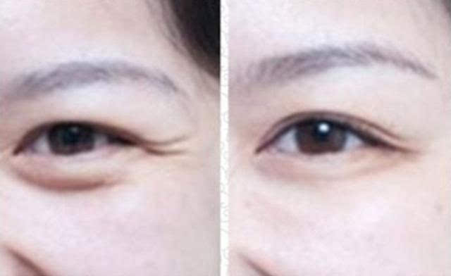 爱皱纹