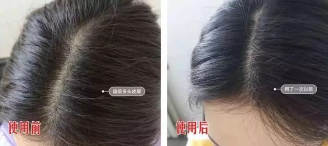 恼人的头皮屑