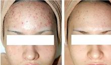 “青春痘”的秘密