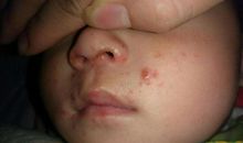 出水痘的日子里