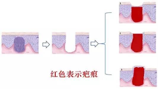 明显的疤痕