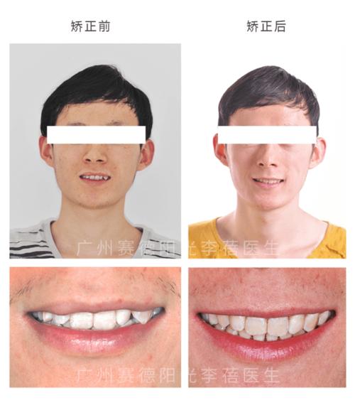牙科矫正