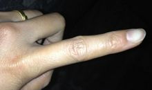 伤疤带来的记忆