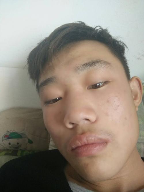 针眼